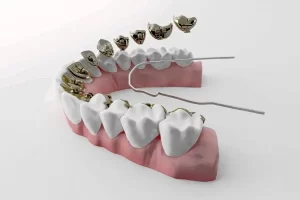 lingual ortodonti 4