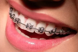 metal braketler 1